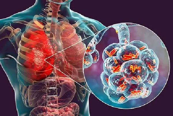 Pneumonia