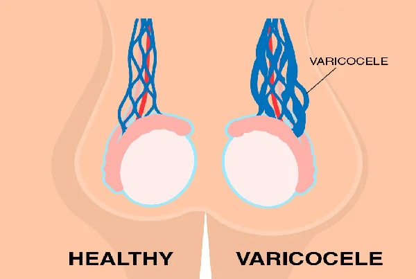 Varicocele